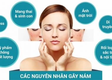 Nám da do rối loạn nội tiết tố